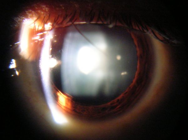 Vue de la lampe à fente de la cataracte dans Oeil humain