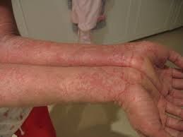 L'incidence de l'eczéma, une affection allergique de la peau, est en augmentation.