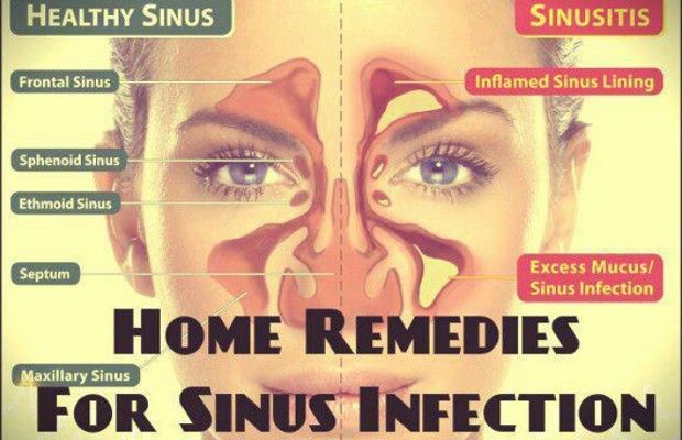 Remèdes maison pour l'infection des sinus