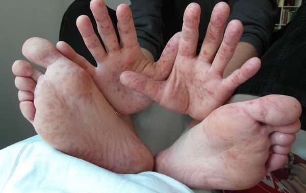 Un nombre croissant d'enfants en Floride sont infectées avec une main, mais, et la fièvre aphteuse.