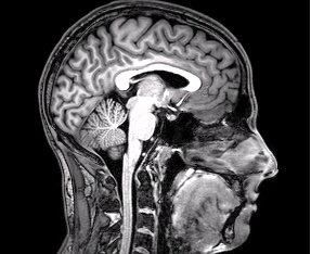 Une IRM du cerveau.