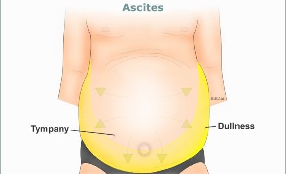 Remèdes à la maison pour le traitement ascite Naturellement
