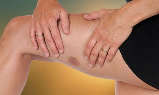Remèdes à la maison pour des contusions bras les jambes cou