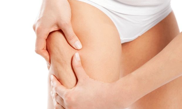 Cause et formation de la cellulite