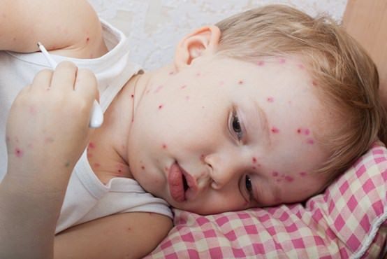 Accueil recours pour Chicken Pox Relief Naturellement