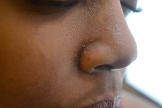 Accueil recours pour Nez Peau sèche