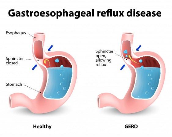 http: images / Accueil-recours-Pour-gastro-oesophagien-Reflux-maladie-GERD.jpg
