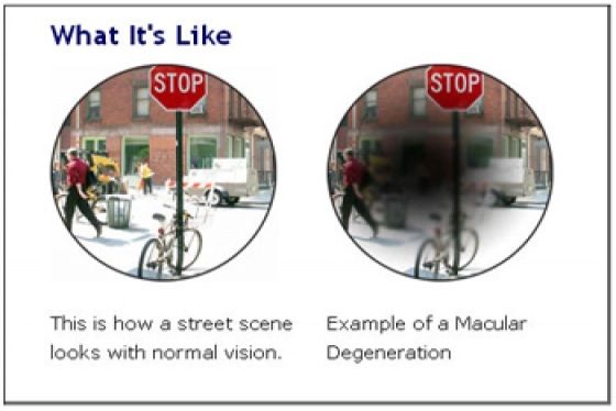 Accueil recours pour Macular Degeneration Traitement naturellement