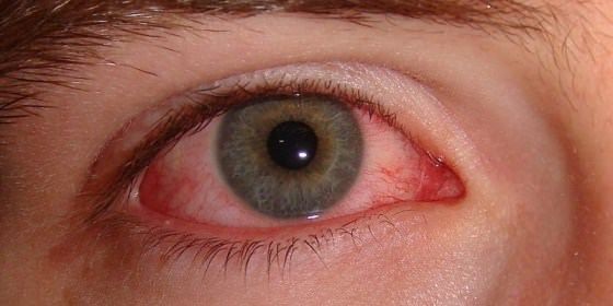 Remèdes à la maison pour Red Eye Treatment Naturellement