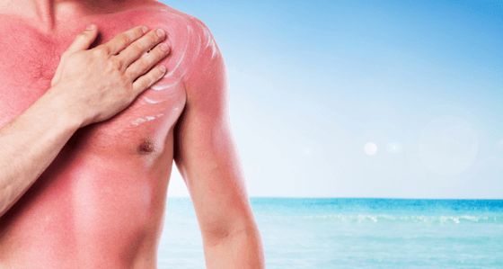 Accueil recours à des soins apaisants Sunburn Naturally