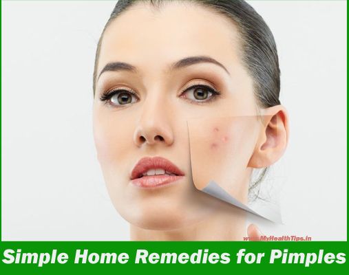 Home Remedies Pour se débarrasser des boutons