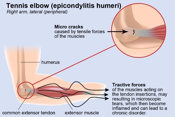 Remèdes à la maison pour guérir Tennis Elbow Naturellement et rapide