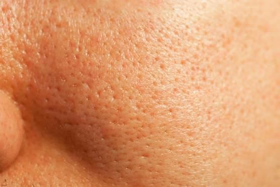 Les remèdes maison pour se débarrasser des pores obstrués