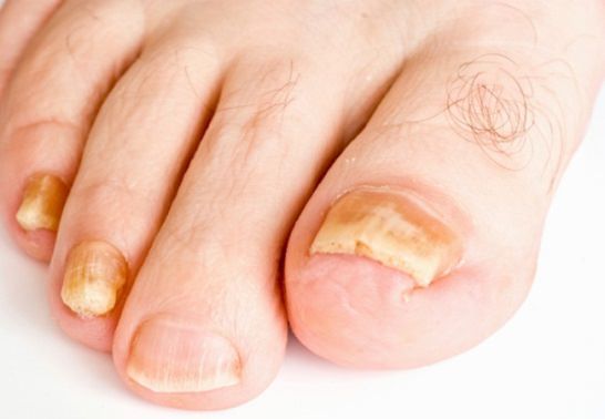 Remèdes à la maison pour se débarrasser de mycose des ongles