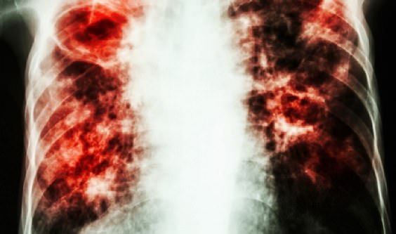 Remèdes à la maison pour traiter le trouble de fibrose pulmonaire