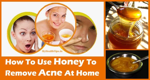 Miel pour l'acné