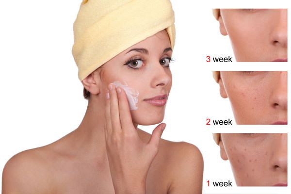 Comment éviter les cicatrices d'acné naturellement après l'acné
