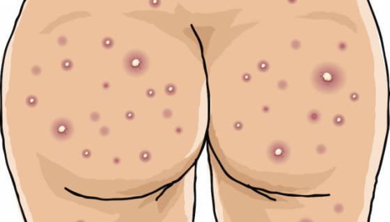 Comment guérir l'acné sur les fesses?