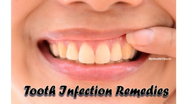 Comment éliminer une infection dentaire à la maison