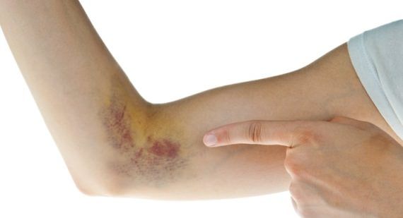 Comment se débarrasser d'un Bruise