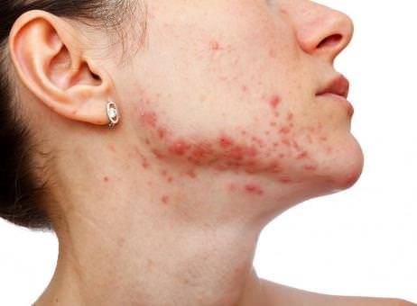 Comment se débarrasser de l'acné