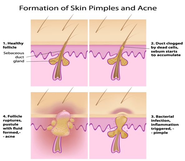 Comment se débarrasser de l'acné rapidement et nuit?