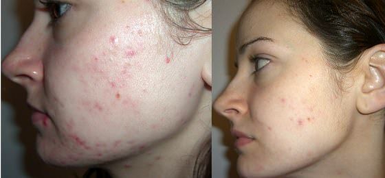 Comment se débarrasser de l'acné en un jour?