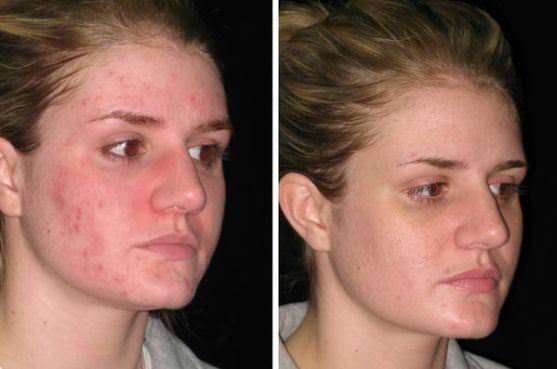 Comment se débarrasser de l'acné naturellement Remèdes à la maison