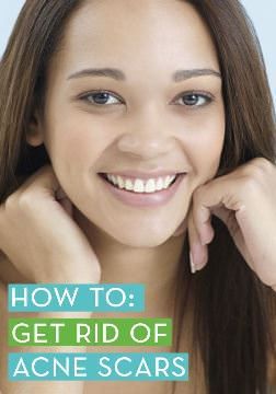 Comment se débarrasser des cicatrices d'acné rapides (estomper les cicatrices d'acné)