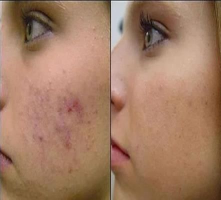 Comment se débarrasser des cicatrices d'acné