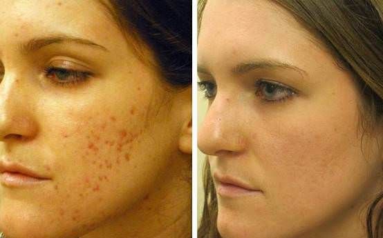 Comment se débarrasser des cicatrices d'acné naturellement sans produits chimiques