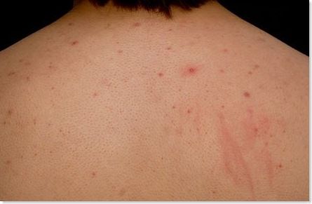 Comment se débarrasser de l'acné dos