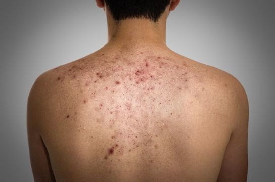 Comment se débarrasser des cicatrices Bacne et Bacne Traitement Naturel