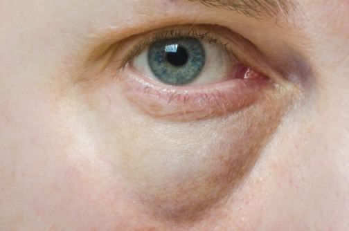Comment se débarrasser des poches sous les yeux rapides