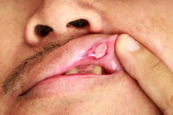 Comment se débarrasser des aphtes
