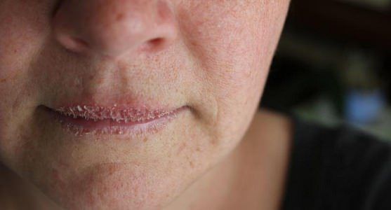 Comment se débarrasser des Lèvres gercées Fast & Naturellement