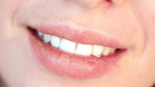 Comment se débarrasser des lèvres gercées utilisant des remèdes maison?