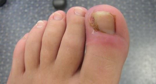 Comment se débarrasser d'ongle incarné à la maison vous-même