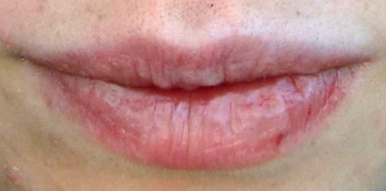 Comment se débarrasser des lèvres gercées douloureuses rapidement et naturellement