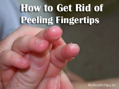 Comment se débarrasser des doigts épluchage