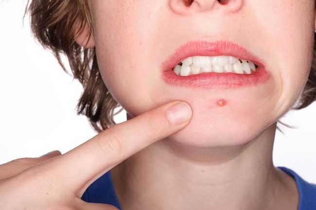 Comment se débarrasser des boutons et des marques Pimple rapides?