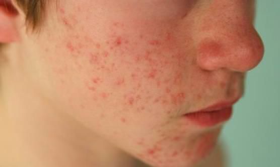 Comment se débarrasser de l'acné chez les adolescentes