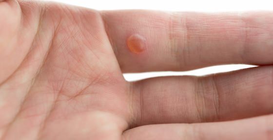 Comment se débarrasser des verrues sur les mains Fingers Visage