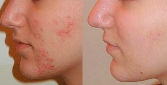 Comment guérir l'acné rapidement et naturellement