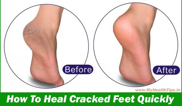 Comment guérir pieds crevassés rapidement