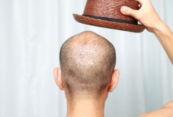 Comment prévenir la perte de cheveux chez les femmes et les hommes