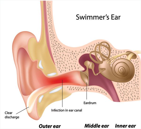 Comment éliminer l'eau des oreilles après la baignade ou le bain (remèdes maison)
