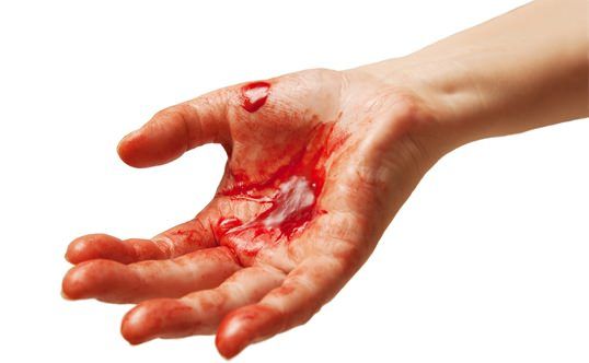 Comment arrêter le saignement des coupures et des Internal Bleeding