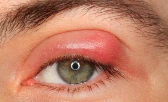 Comment traiter un orgelet