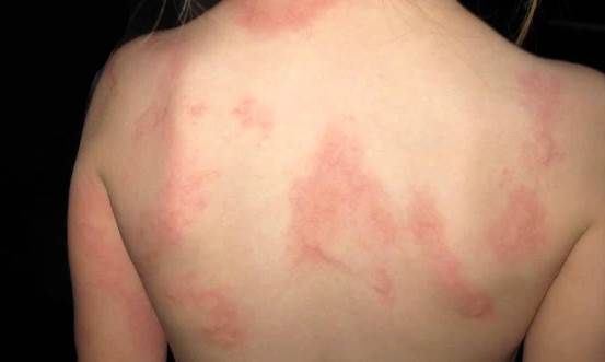 Comment traiter l'urticaire Naturellement